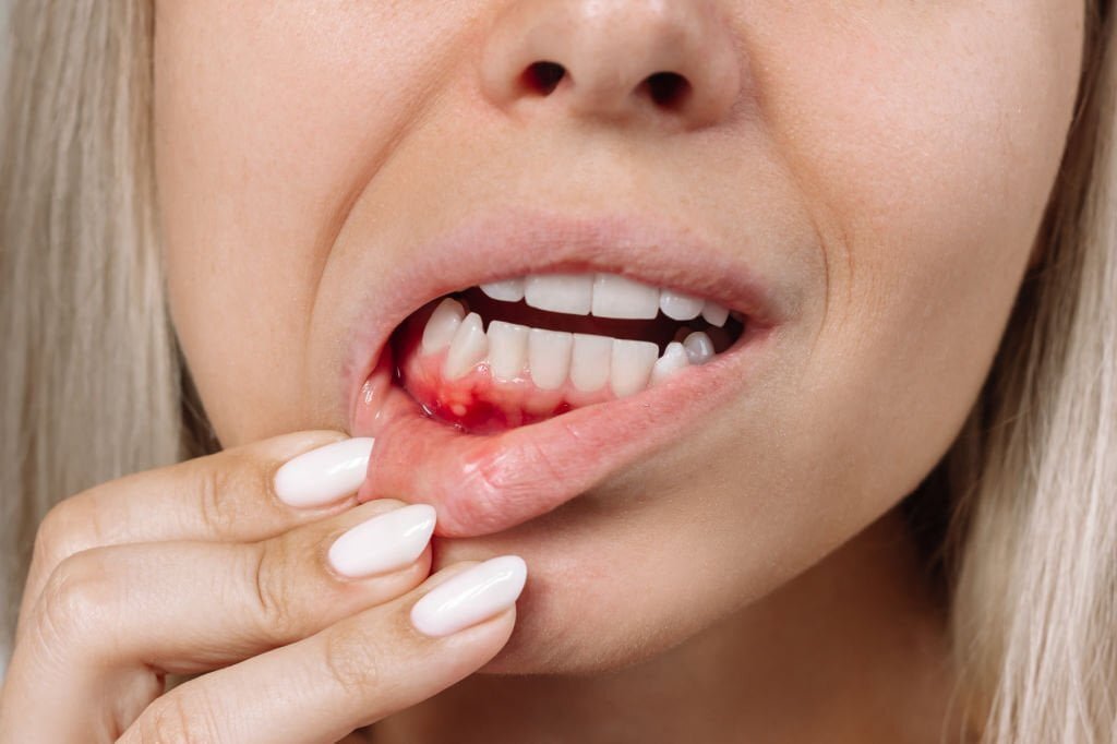 Cut on Gums: Causes, Treatments, and Preventions